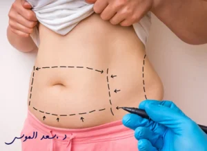 عملية شفط الدهون في الرياض