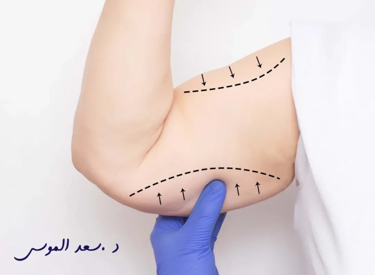 تجربتي مع شفط دهون الذراعين