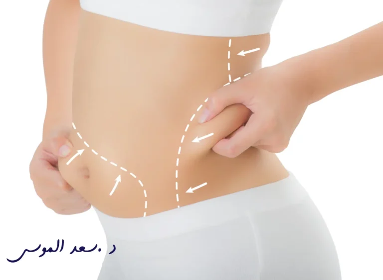 تجربتي مع عملية شفط الدهون