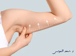 عملية شد الزنود