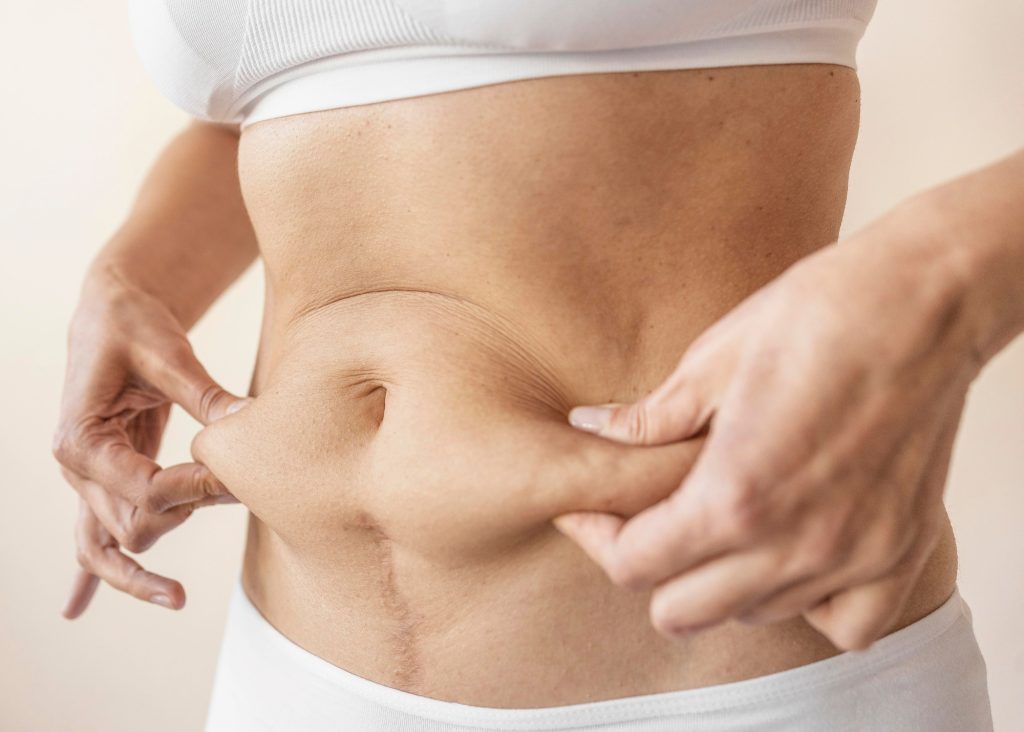 Mommy Makeover: A Personalised Approach to Post-Pregnancy Body Changes
